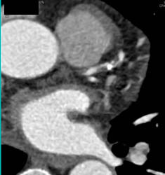 LAD Stenosis - CTisus CT Scan