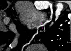 LAD Stenosis - CTisus CT Scan