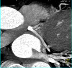 LAD Stenosis - CTisus CT Scan