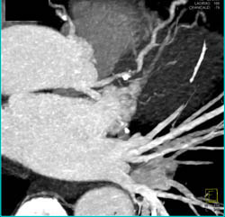 LAD Stenosis - CTisus CT Scan