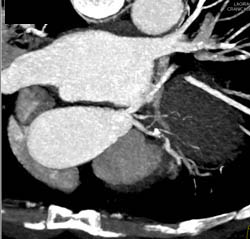 LAD Stenosis - CTisus CT Scan