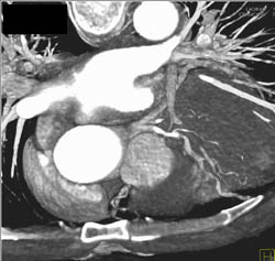 LAD Stenosis - CTisus CT Scan