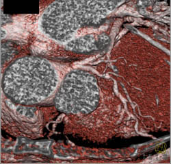 LAD Stenosis - CTisus CT Scan