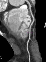 LAD Plaque Without Critical Stenosis - CTisus CT Scan