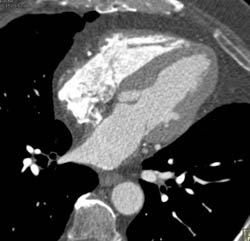 Bypass Graft to Circumflex - CTisus CT Scan