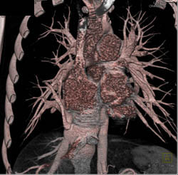 Total Anomalous Pulmonary Venous Return- TAPVR - CTisus CT Scan