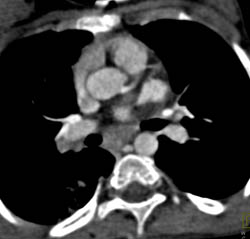 Right Aortic Arch and Incomplete Ring - CTisus CT Scan