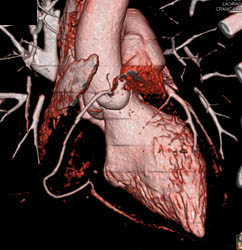 Normal CCTA - CTisus CT Scan