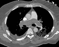 Pulmonary Artery Syndrome Simulates Saddle PE - CTisus CT Scan