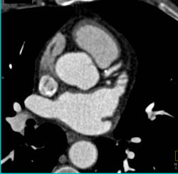 Plaque LAD Eithout Stenosis - CTisus CT Scan