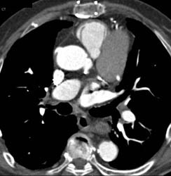 Patent Left Internal Mammary Artery (LIMA) Graft and Two Venous Grafts - CTisus CT Scan