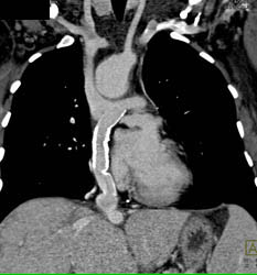 Conduit Pa to IVC - CTisus CT Scan