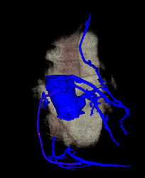 Patent Left Internal Mammary Artery (LIMA) Grafts - CTisus CT Scan