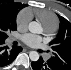 RCA Off Left Cusp - CTisus CT Scan