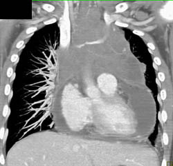 Lymphoma Invades the Pericardium - CTisus CT Scan