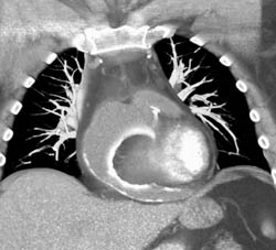 Calcified Pericardial Cyst - CTisus CT Scan