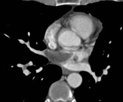 Metastases to Left Atrium - CTisus CT Scan