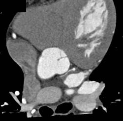 Nice Sa Node Branch Off Circumflex - CTisus CT Scan