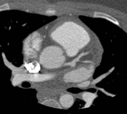 LAD Aneurysm in Kawasaki Disease - CTisus CT Scan