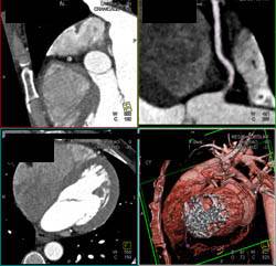 Plaque in RCA Proximally - CTisus CT Scan