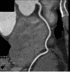 Plaque Proximal RCA - CTisus CT Scan