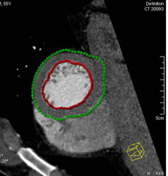 Volume Mapping Off Left Ventricle - CTisus CT Scan