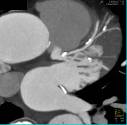 Calcified Plaque LAD and Circumflex and Ramus Intermedius in Multiple Views - CTisus CT Scan