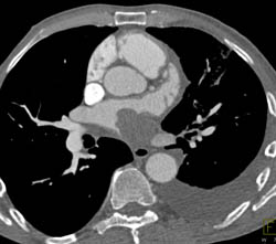 Lung Cancer- NSCLC- Invades the Left Atrium - CTisus CT Scan