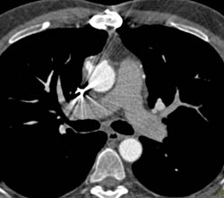 Patent Venous Bypass Graft - CTisus CT Scan