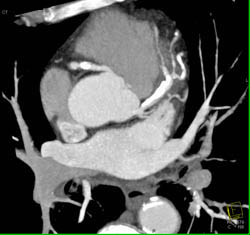 Greater Than 50% LAD Stenosis - CTisus CT Scan