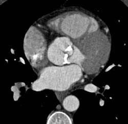 Calcified Aortic Valve and LAD Plaque - CTisus CT Scan