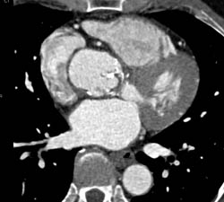 Severe Aortic Valve Calcification - CTisus CT Scan