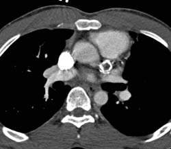 Calcified Circumflex Coronary Artery Aneurysm - CTisus CT Scan