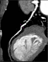 LAD Stenosis Greater Than 70% - CTisus CT Scan