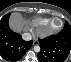 Thrombus in Left Ventricle - CTisus CT Scan