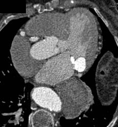 Circumflex Coronary Artery Aneurysm - CTisus CT Scan