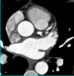 LAD Stenosis in Multiple Perspectives - CTisus CT Scan