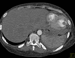 Prior LV Infarct - CTisus CT Scan