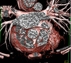 Left Coronary Artery Arises Off the Pulmonary Artery - CTisus CT Scan