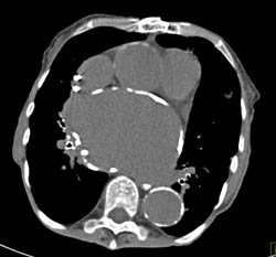 Left Atrial Aneurysmal Dilation With Calcification - CTisus CT Scan