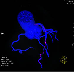 LAD Disease With 50% Stenosis - CTisus CT Scan