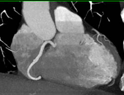 Plaque RCA Without Stenosis - CTisus CT Scan