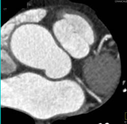 Minimal Plaque - CTisus CT Scan