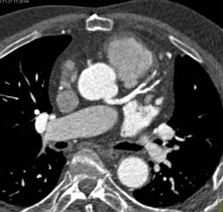 LAD Stenosis and Calcified Plaque - CTisus CT Scan