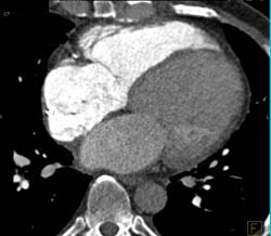 Right Sided Heart Opacification - CTisus CT Scan