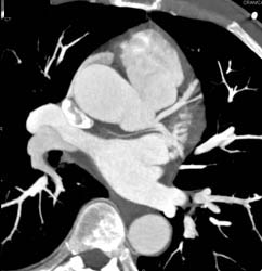 Sa Nodule Branch Off Circumflex Coronary Artery - CTisus CT Scan