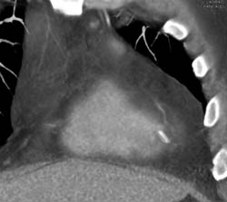 Clip Lodged Into Ventricular Muscle - CTisus CT Scan