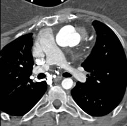 Dilated Coronary Artery S/P Repair of Root - CTisus CT Scan