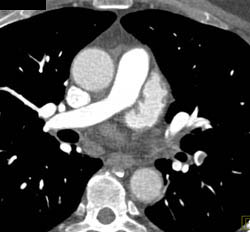 Pulmonary Embolism (PE) in Left Lower Lung - CTisus CT Scan