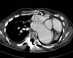 Complex Anatomy With Single Ventricle - CTisus CT Scan